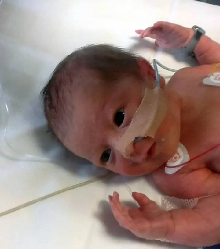 Baby River treated at St Michael's Neonatal Intensive Care Unit. 