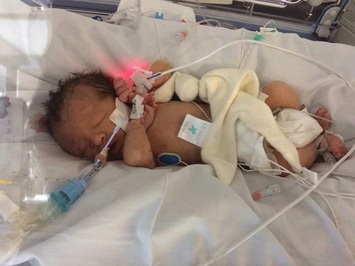 Baby Aimee, treated in St Michael's Neonatal Intensive Care Unit. 