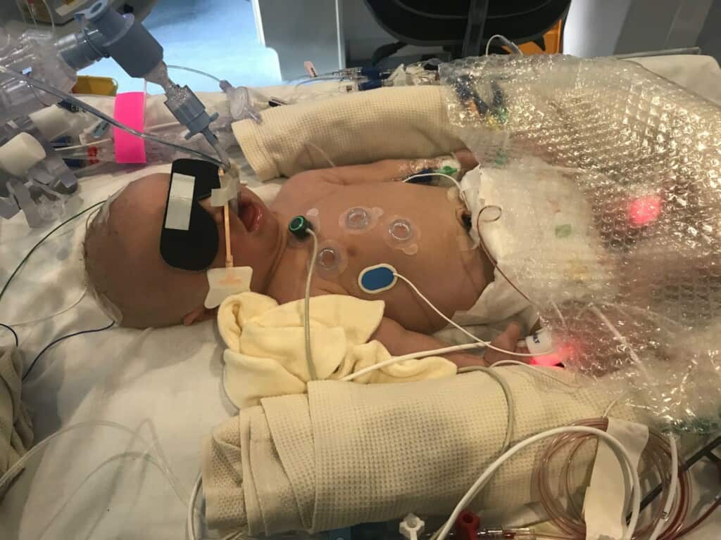 Bertie in St Michael's Neonatal Intensive Care Unit, Bristol.