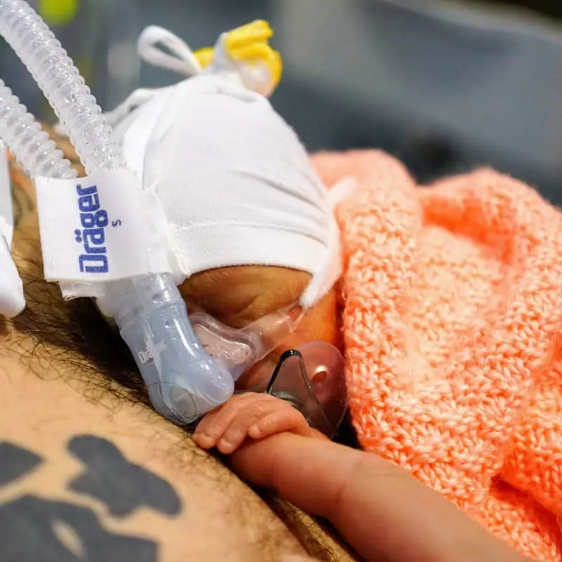 A baby being treated at St Michael's Hospital Neonatal Intensive Care Unit. 