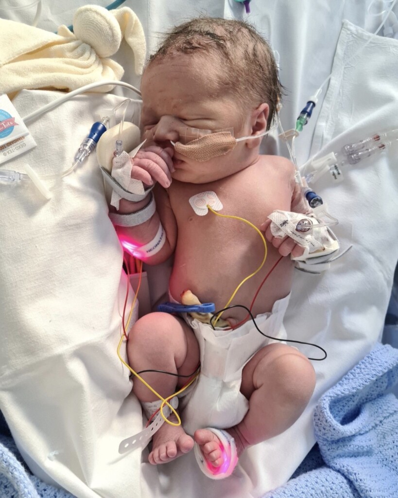 Miles in St Michael's NICU.